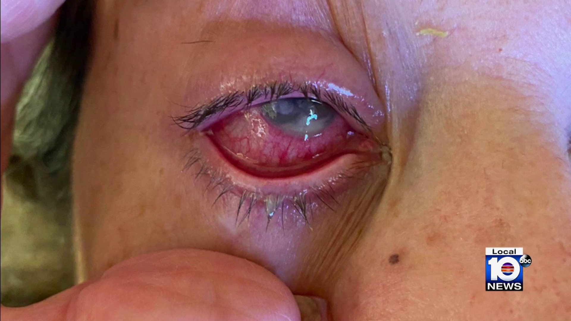 South Florida grandmother claims eyedrops caused blindness