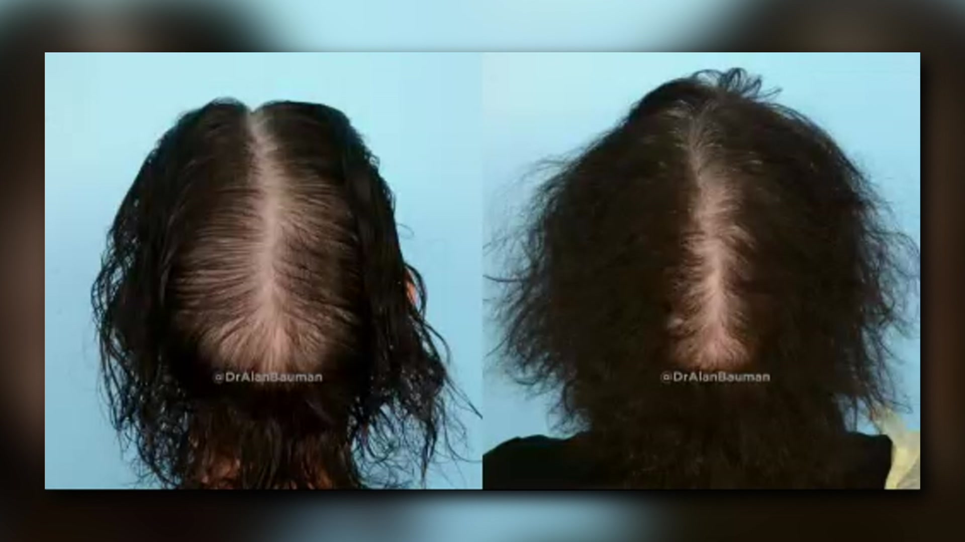 Is it possible for people to avoid genetic hair loss