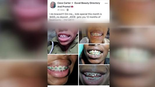 Botched Braces Dentists Concerned About Woman S Facebook Ad For At Home Orthodontics